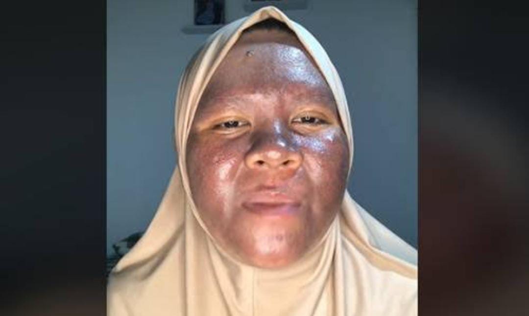 Fakta Wanita Cantik Asal Kalimantan yang Wajahnya Gosong Akibat Krim Merkuri, Mulanya Wajahnya Sangat Glowing