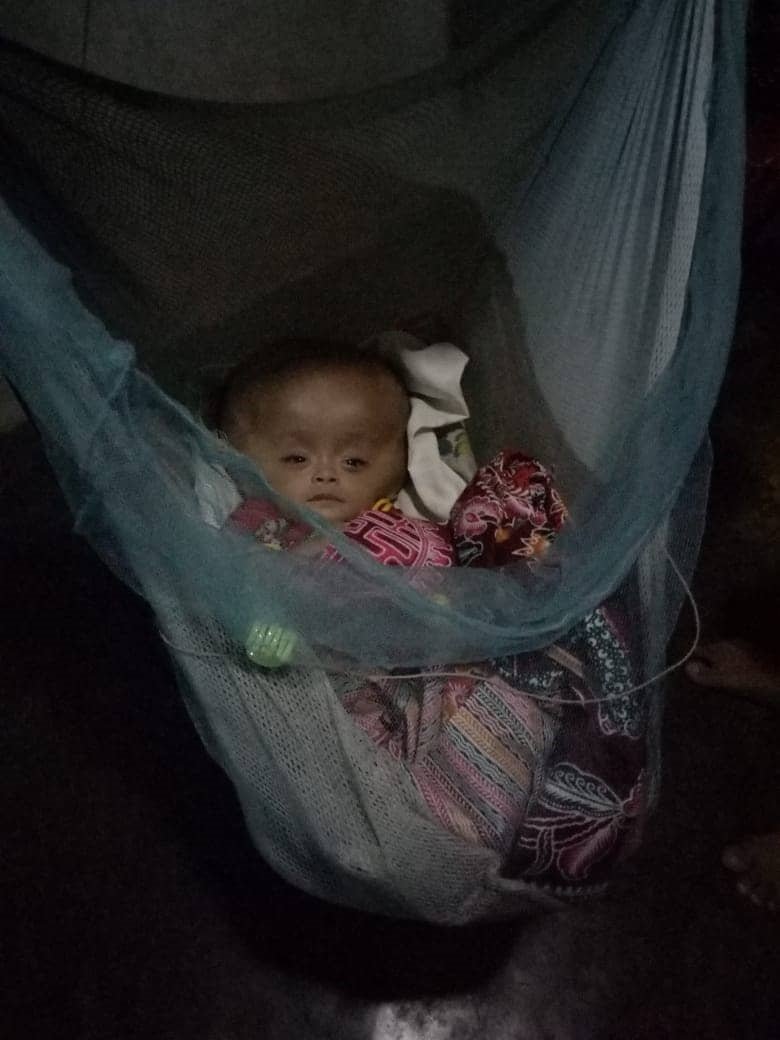 Bayi Hidrosefalus Masih Butuh Bantuan