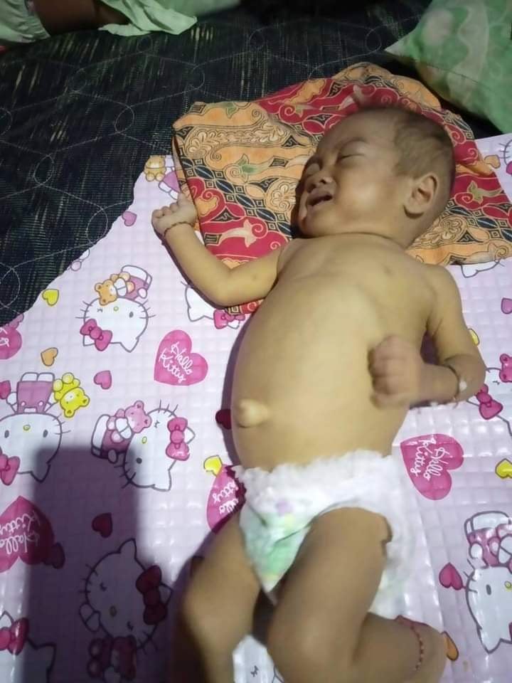 Bayi Penderita Atresia Bilier Berpulang