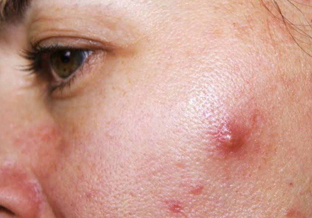 Ketahui 5 Cara Menghilangkan Jerawat Batu secara Efektif 