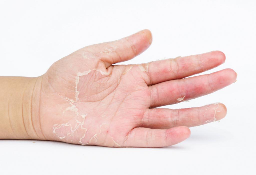 Kulit Telapak Tangan Mengelupas? Ini Penyebab dan Cara Mengatasinya