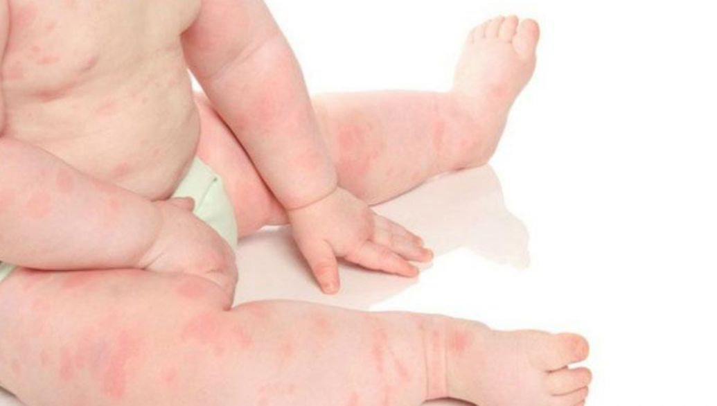 Apa Penyebab Biduran pada Anak? Begini Cara Mengatasinya