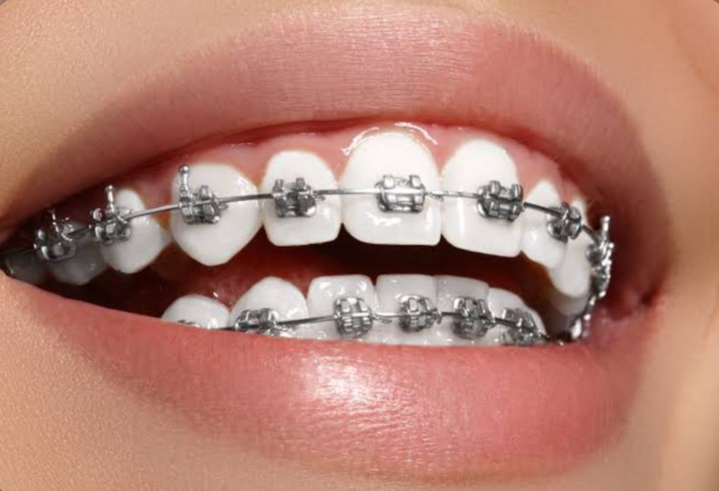 Apakah Biaya Pasang Behel Bisa Ditanggung BPJS Kesehatan? Cek Ketentuannya Sekarang