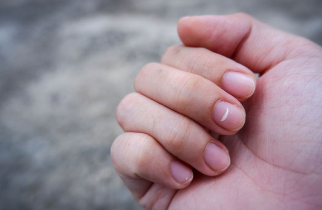 Tanda Putih pada Kuku, Ini Penyebab dan Cara Penanganannya