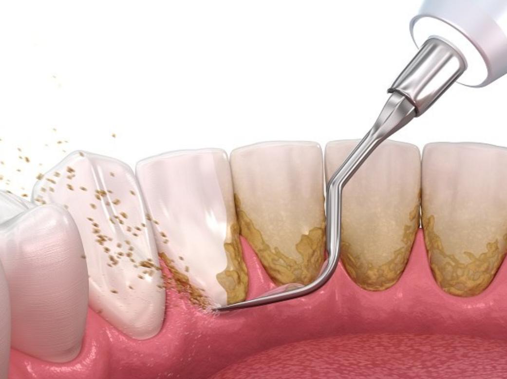 Begini Cara Merontokkan Karang Gigi dengan Baking Soda