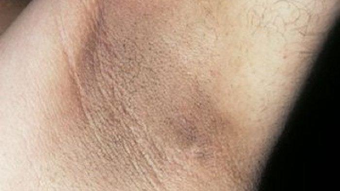 Hanya Gunakan Bahan Alami, Ketiak Bau dan Menghitam Bisa Menghilang Tanpa Sisa