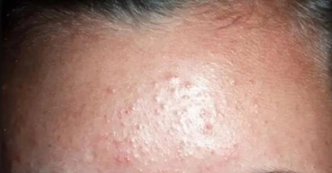 Ini Tanda Bruntusan Akan Hilang dan Sembuh, Salah Satunya Komedo Semakin Berkurang 