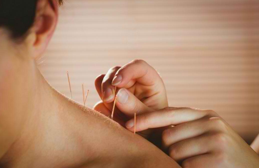 Menyingkap Resiko Terapi Akupunktur bagi Kesehatan