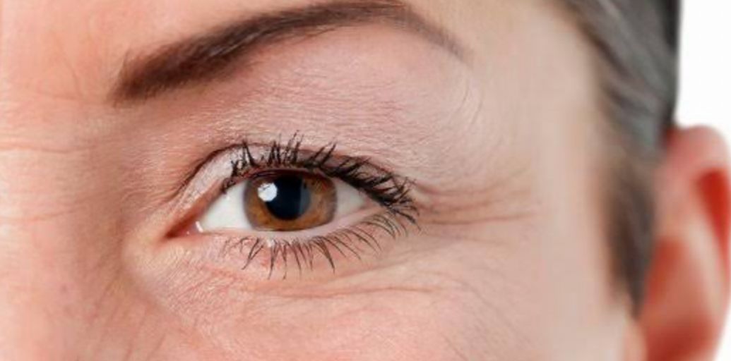 Ini Berbagai Perawatan Medis untuk Mengatasi Kerutan di Bawah Mata Secara Cepat