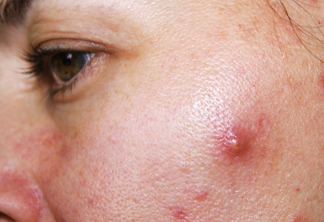 Ketahui Ini Ciri-ciri Jerawat yang Disebabkan Wajahmu tak Cocok Gunakan Produk Skincare