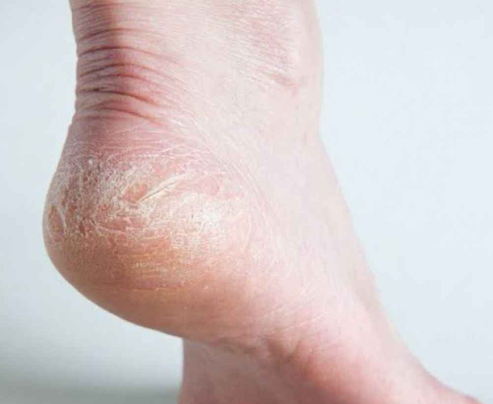 Kaki Pecah-Pecah? Ini Solusi Ampuh yang Bisa Dilakukan