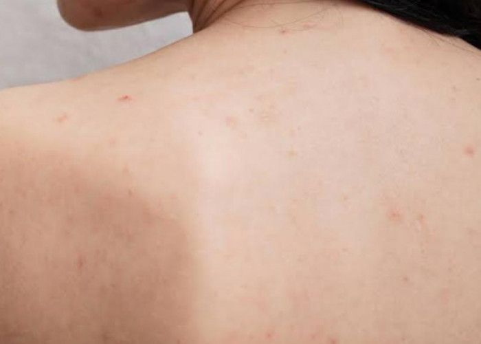 Bukan Hanya Wajah, Ternyata Bagian Tubuh Ini Juga Kerap Muncul Bintik Hitam