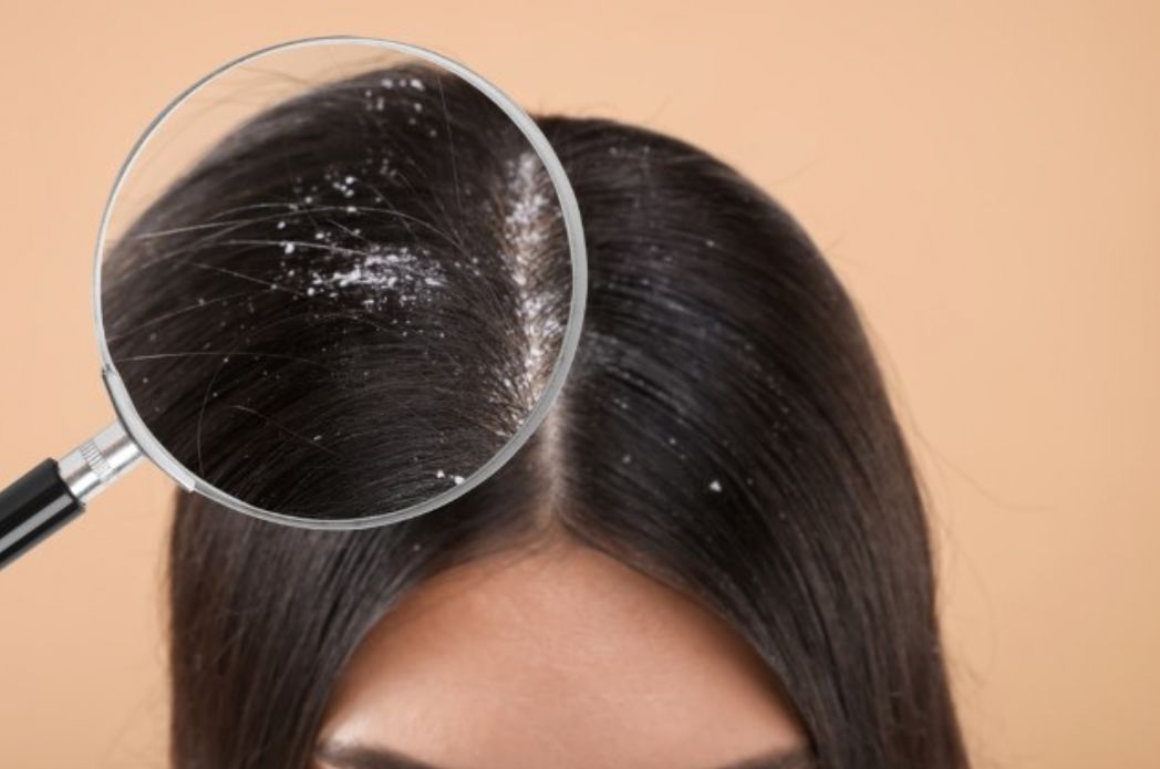 Mengenal 6 Masalah Rambut Akibat Kulit Kepala yang Tidak Terawat dan Cara Mengatasinya 