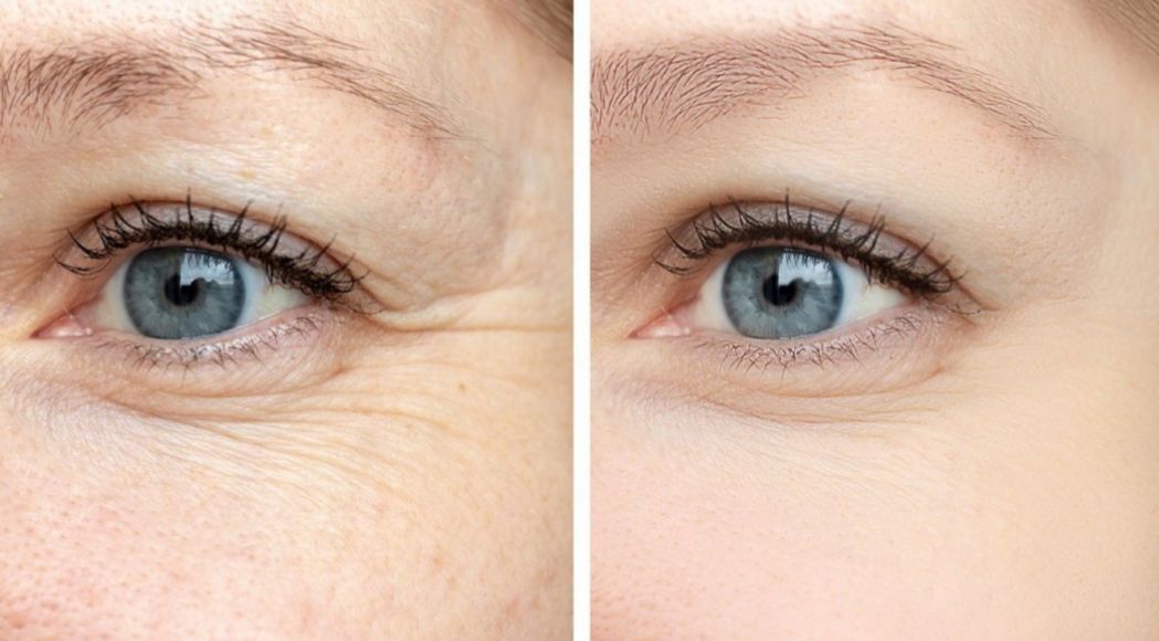 Wajib Dicoba! Ini Cara Menghilangkan Kerutan di Bawah Mata Secara Alami