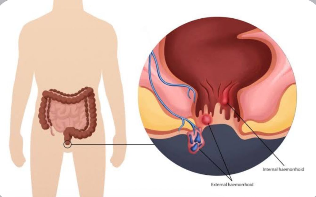 Jangan Khawatir, Ini Cara Alami untuk Mengatasi Ambeien