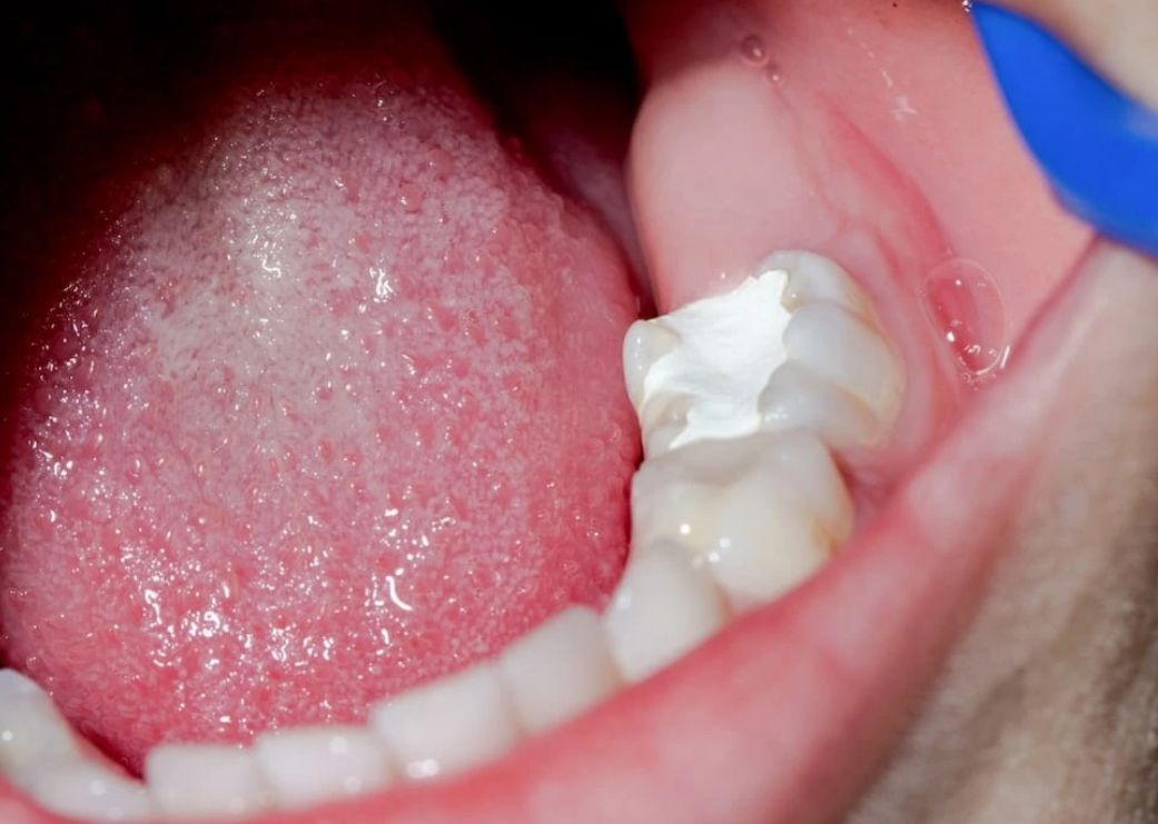 Mengenal Jenis-jenis Tambal Gigi Berdasarkan Bahannya