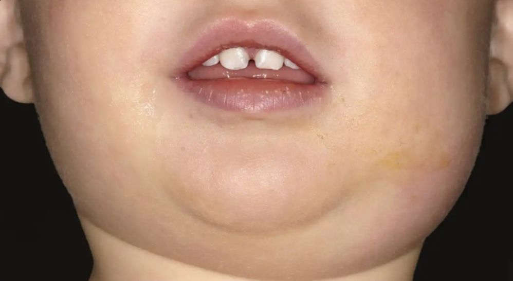 Pahami Penyebab Gondongan pada Anak yang Seringkali Tidak Disadari