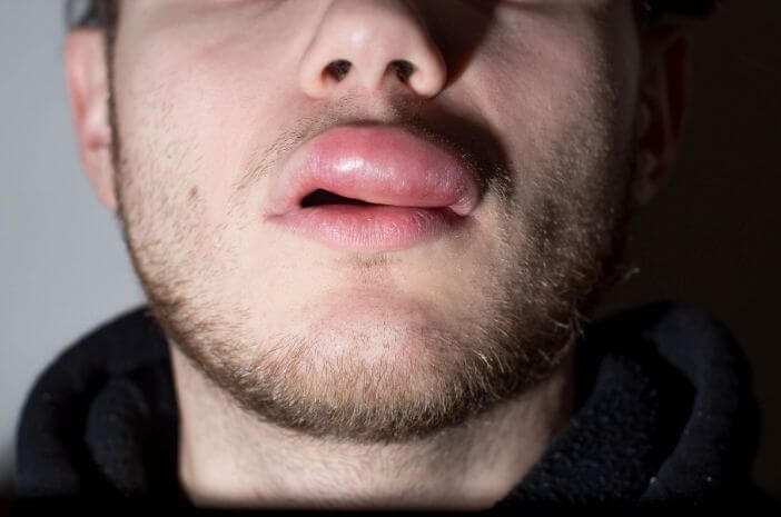 Bibir Bengkak Bikin Engga Pede? Kenali Penyebab dan Cara Mengatasinya