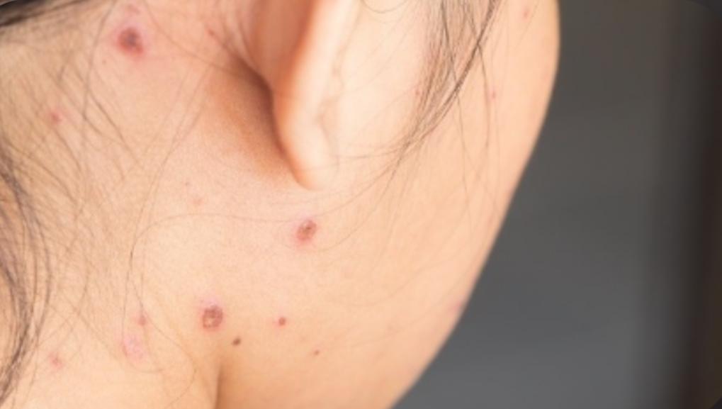 5 Pilihan Obat Cacar Air agar Cepat Kering dan Hilang