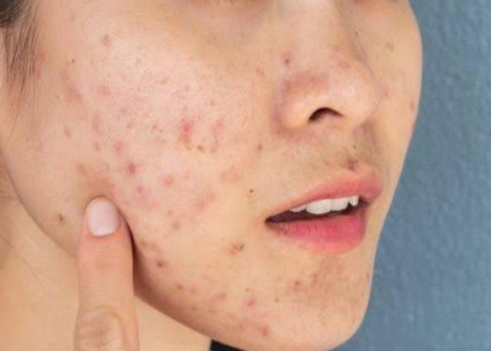 Bukan Jerawat Biasa, Jika Terdapat di Dagu dan Leher Bisa Jadi itu Jerawat Hormonal