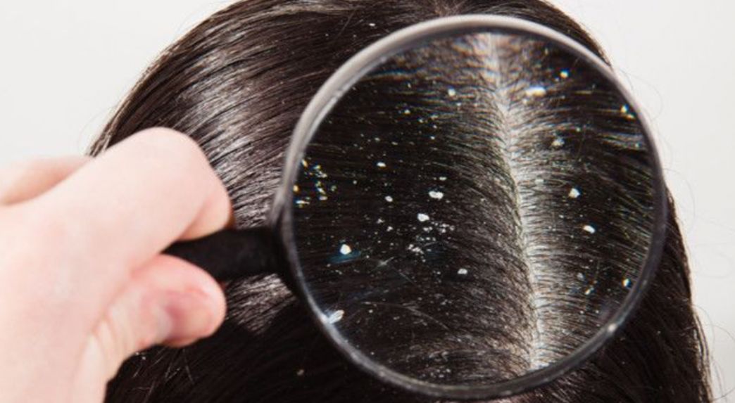 Mirip Tapi tak Sama, Ini Perbedaan Ketombe Basah dan Kering