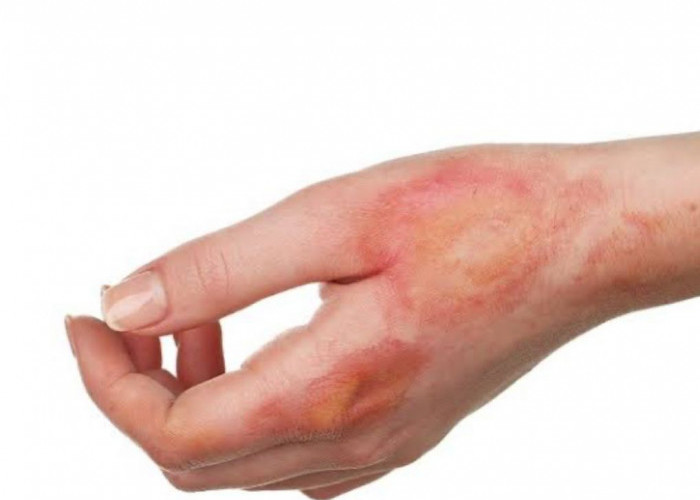 Luka Bakar Bisa Lama Sembuhnya Jika Kulitmu Dehidrasi, Kenali Cirinya Sekarang