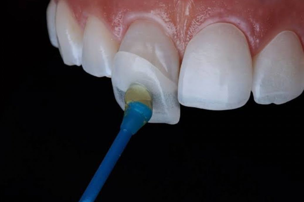 Sebelum Terlambat, Ketahui 5 Efek Samping Veneer Gigi