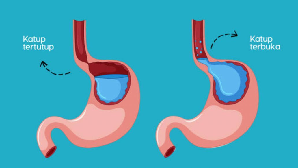 4 Makanan dan Minuman yang Pantang Dikonsumsi Penderita GERD