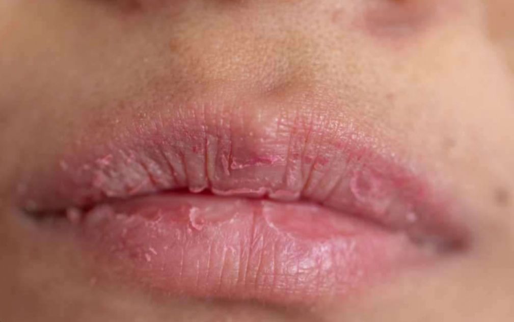 Tanpa Disadari, Ini 6 Kebiasaan Sehari-hari yang Bikin Bibir Kering dan Mengelupas