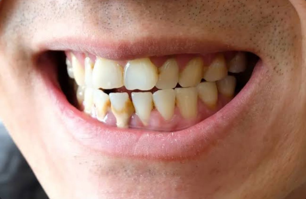 Kebiasaan Sederhana yang Ampuh Mencegah Munculnya Karang Gigi