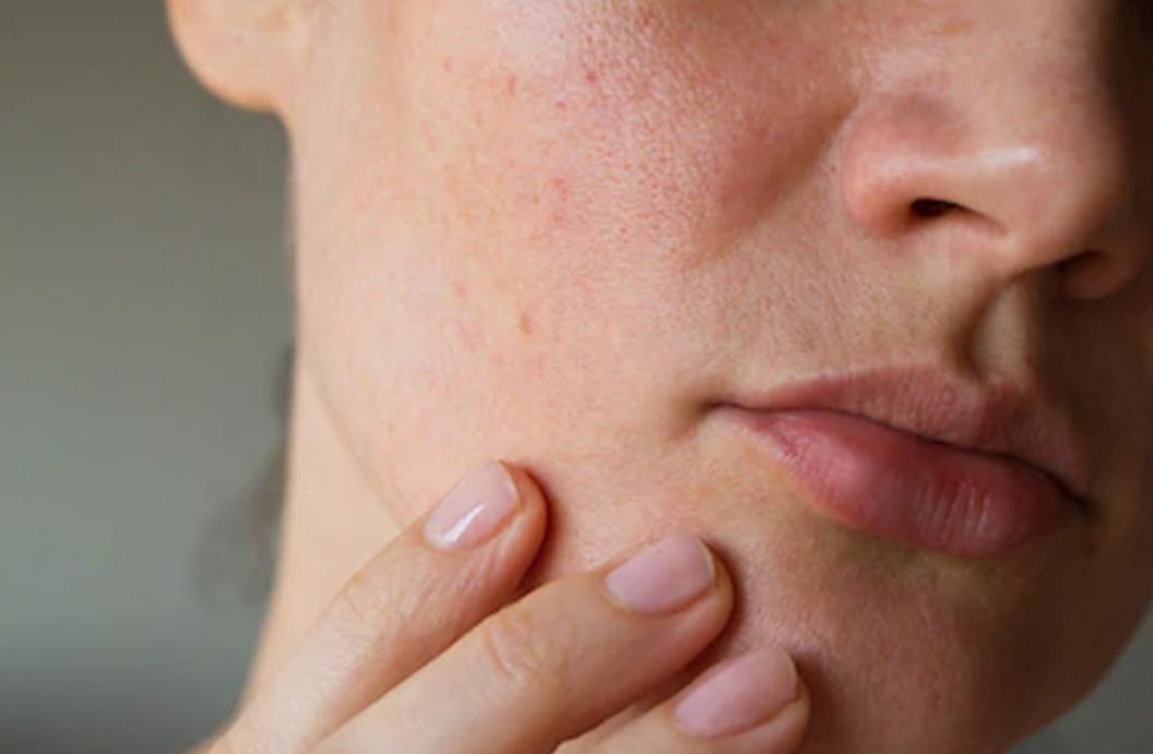 10 Cara Membersihkan Sel Kulit Mati agar Wajah Makin Cerah