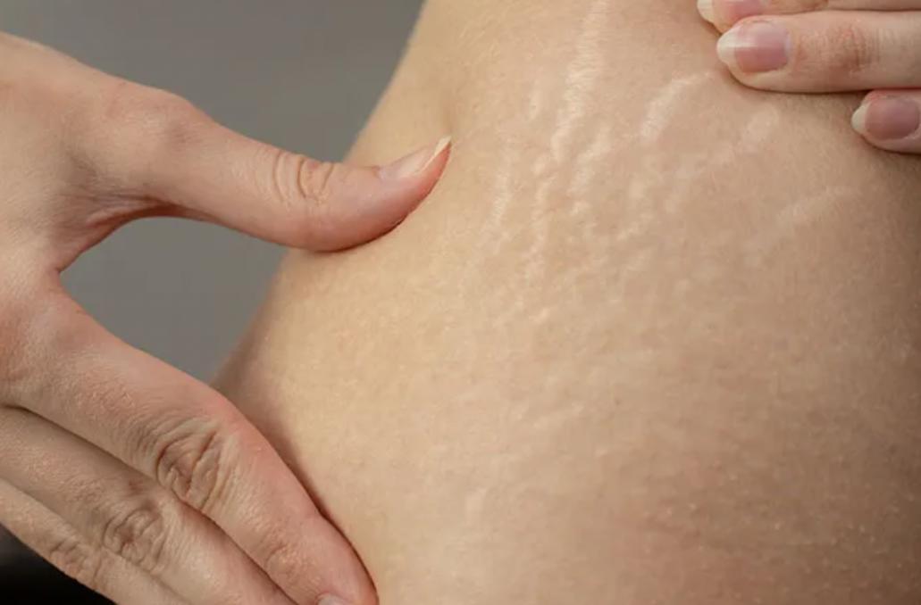 6 Cara Menghilangkan Stretch Mark dengan Bahan Alami