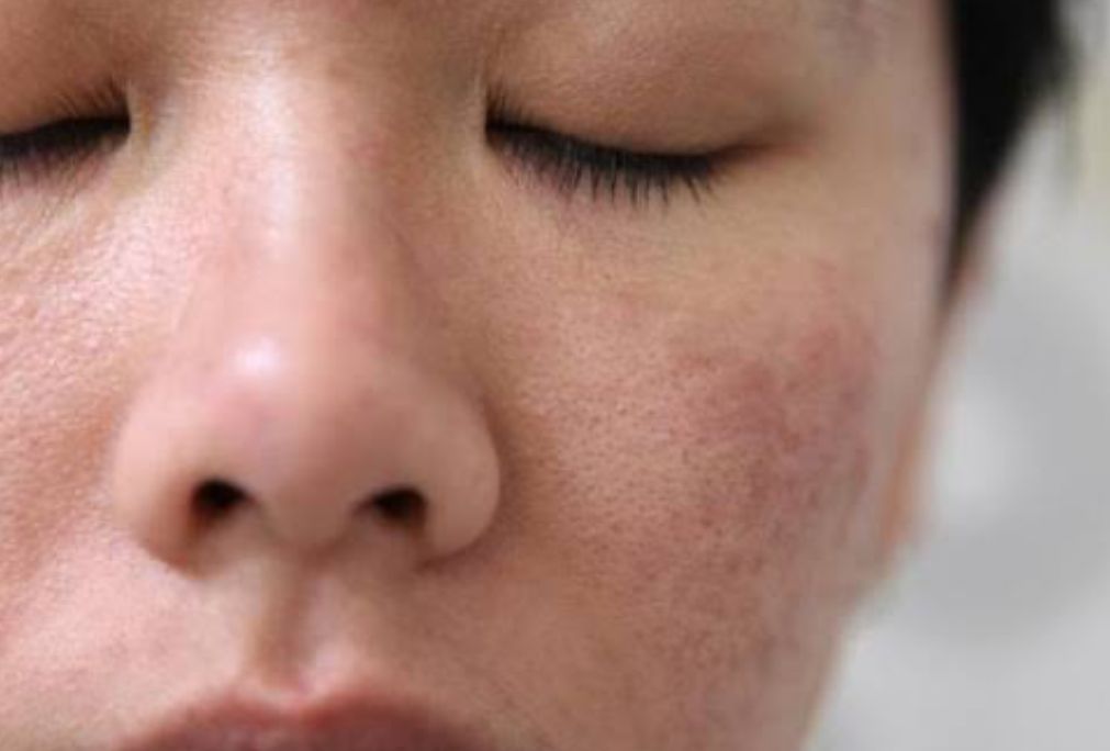 Ketahui, Ini 4 Ciri-ciri Skin Barrier Rusak dan Cara Memperbaikinya