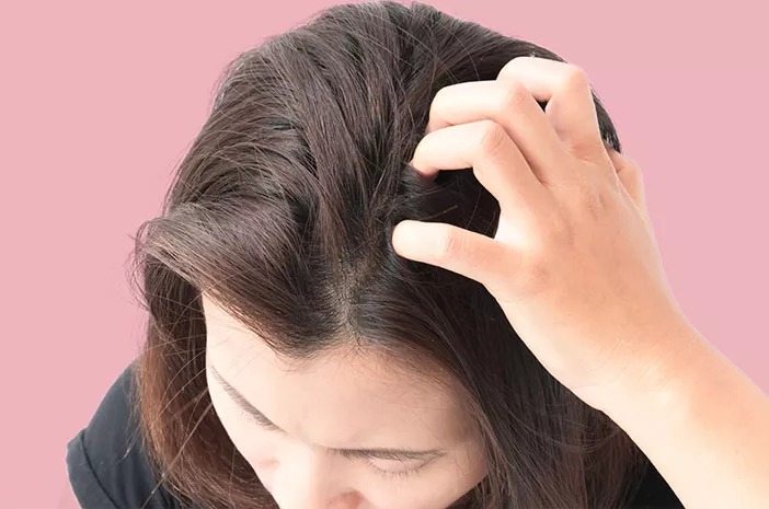 Kutu Rambut Bisa Sangat Mengganggu, Ini Cara Lepas dari Gangguan Ini