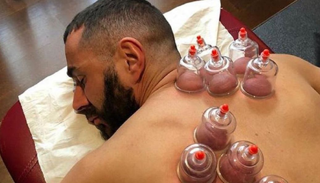 5 Manfaat Terapi Bekam untuk Kesehatan yang Wajib Kamu Ketahui!