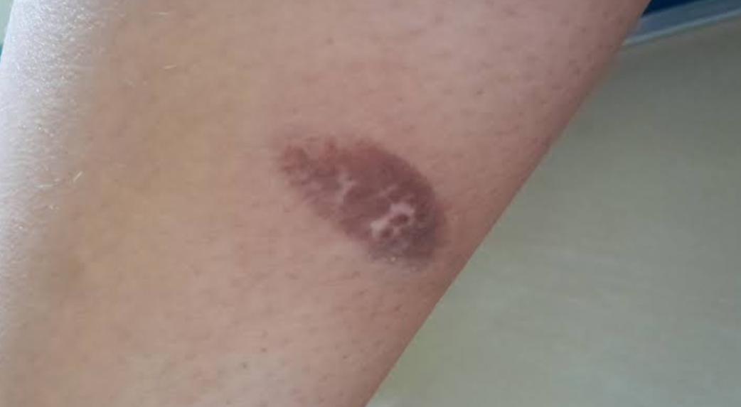 Jangan Sembarangan, Ini Pertolongan Pertama pada Luka Bakar Knalpot