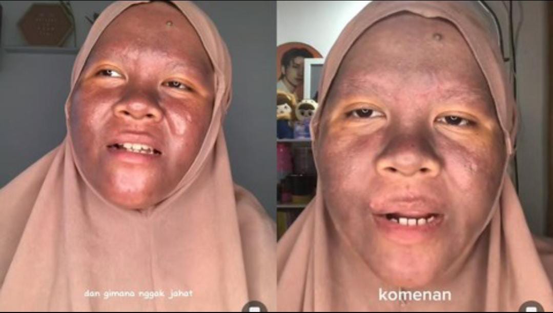 Viral : Korban Janji Glowing Krim Pemutih, Wajah Wanita Cantik Asal Kalimantan Ini Berubah Jadi Gosong