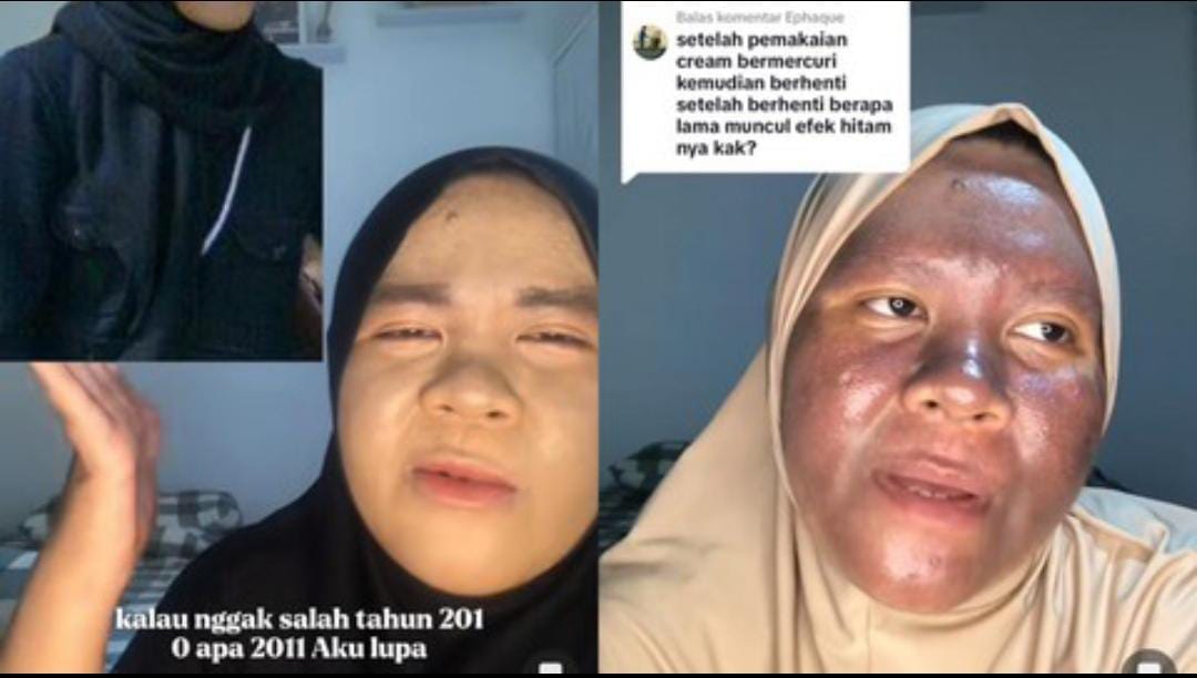 Bertahun-Tahun Pakai Skincare Mengandung Merkuri, Wajah Glowing Wanita Kalimantan Ini Menggosong