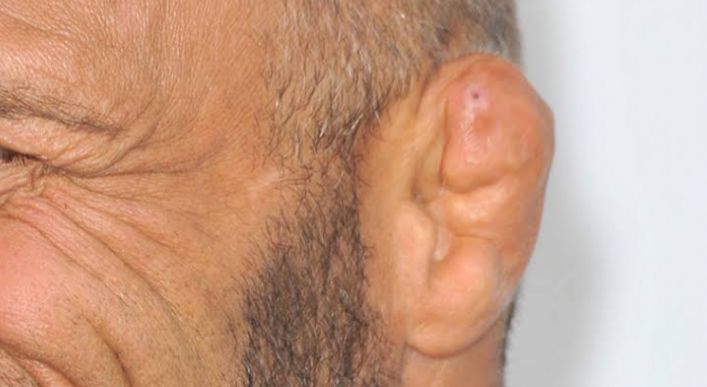 5 Fakta Menarik Cauliflower Ear, Telinga Mirip dengan Kembang Kol