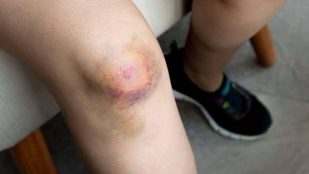 6 Cara Cepat Menghilangkan Memar Biru di Kaki, Bisa Jadi Langkah Penanganan Pertama