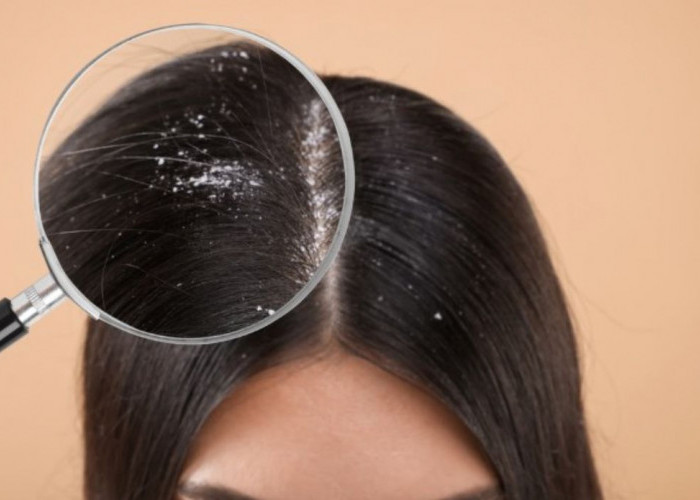 Rambutmu Dijamin Bebas Ketombe Jika Gunakan Sampo yang Tepat