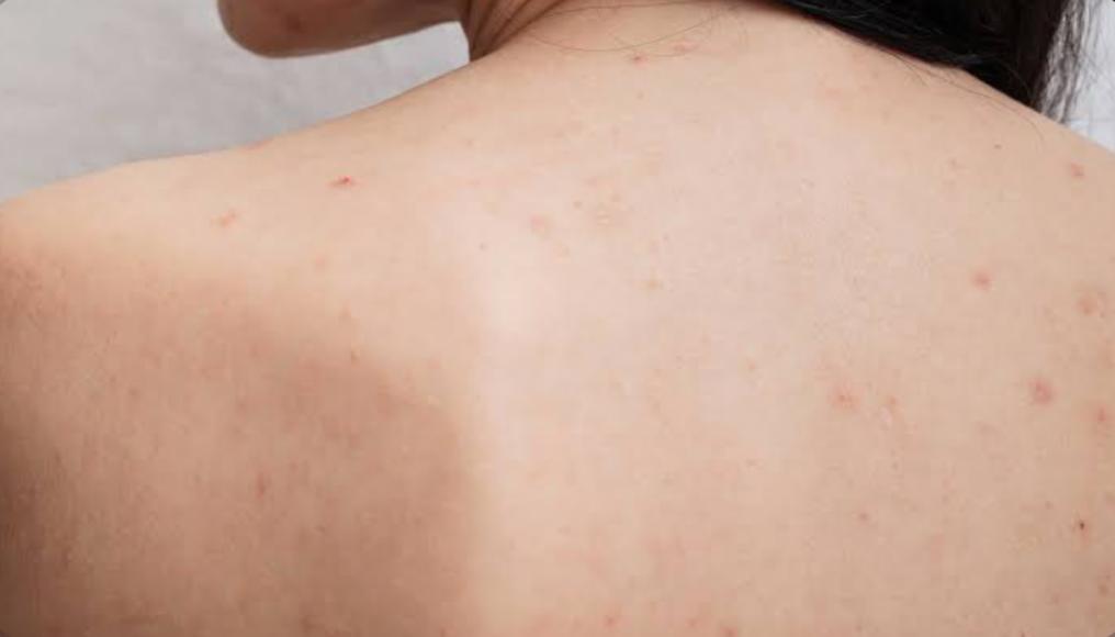 Jerawat Punggung Tak Kunjung Hilang? Coba 8 Cara Ini untuk Mengatasinya 