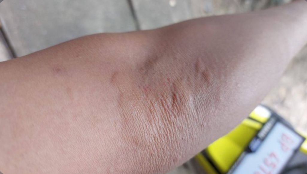 Bukan Digaruk, Ini Cara Mudah Menghilangkan Gatal Akibat Ulat Bulu