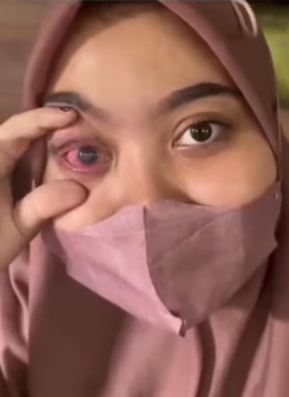 Diduga Iritasi Setelah Memakai Eyelash atau Bulu Mata Palsu, Kornea Mata Perempuan Cantik Asal Jogja Terluka