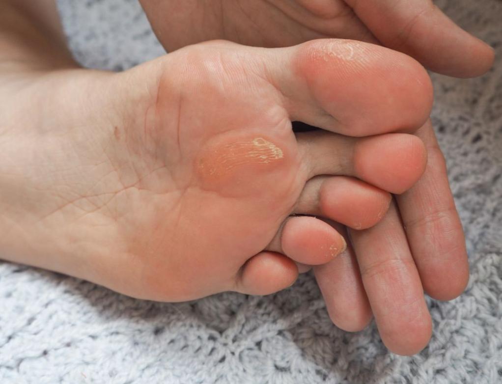 5 Tips Agar Kaki Bebas dari Kutu Air Setelah Terendam Banjir