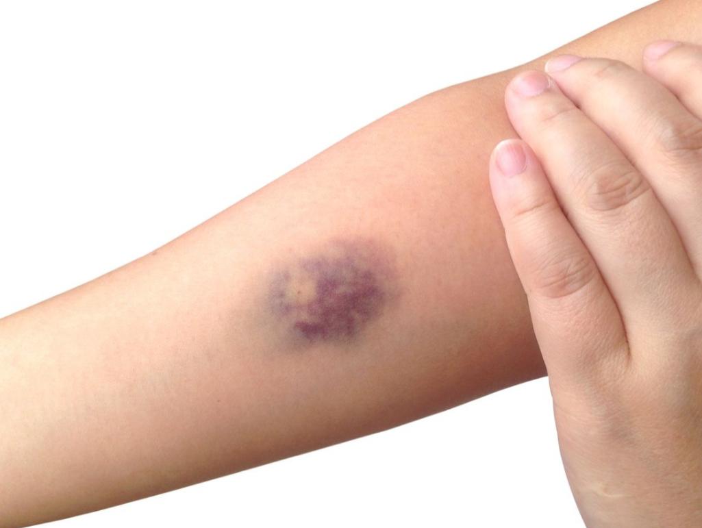 Waspada Memar Tanpa Sebab dan Cara Penanganan yang Tepat 