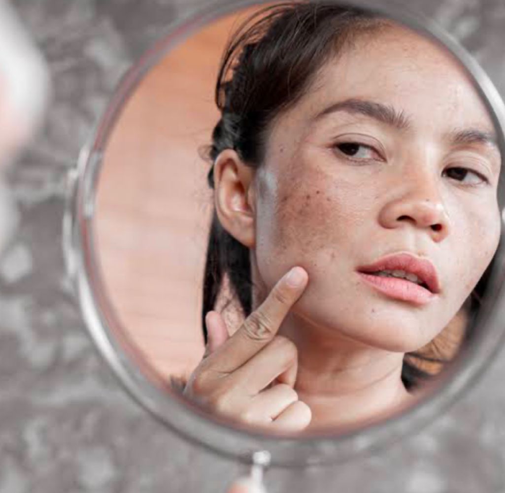 Ini Kandungan Skincare untuk Hilangkan Flek Hitam