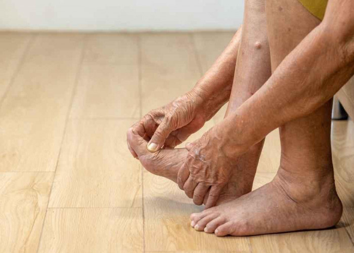 6 Ciri Asam Urat Tinggi di Lutut dan Pelajari Cara Mengatasinya