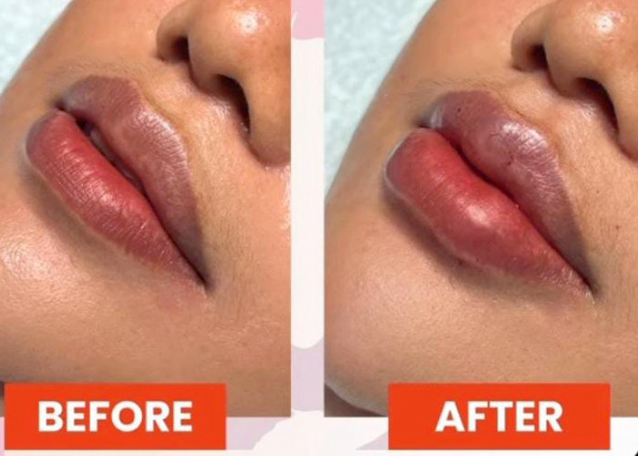 Ada Promo di Klinik Kecantikan Arga Makmur, Makin Seksi dengan Filler Bibir