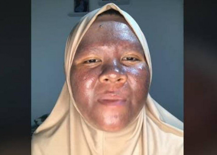 Fakta Wanita Cantik Asal Kalimantan yang Wajahnya Gosong Akibat Krim Merkuri, Mulanya Wajahnya Sangat Glowing